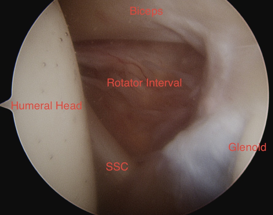 Shoulder Arthroscopy Rotator Interval